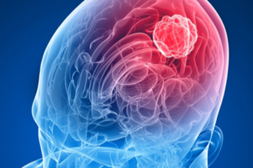 Neuro-Oncology tumor shows in brain alert red