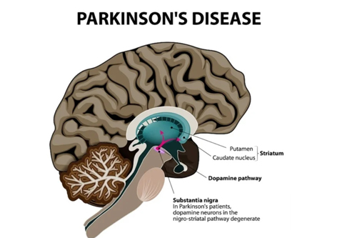 Parkinson's disease In Nagpur brain shows part