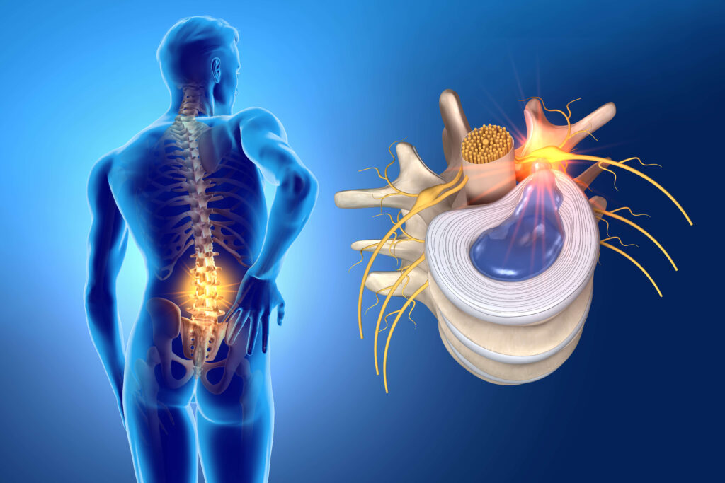 Disc herniation
