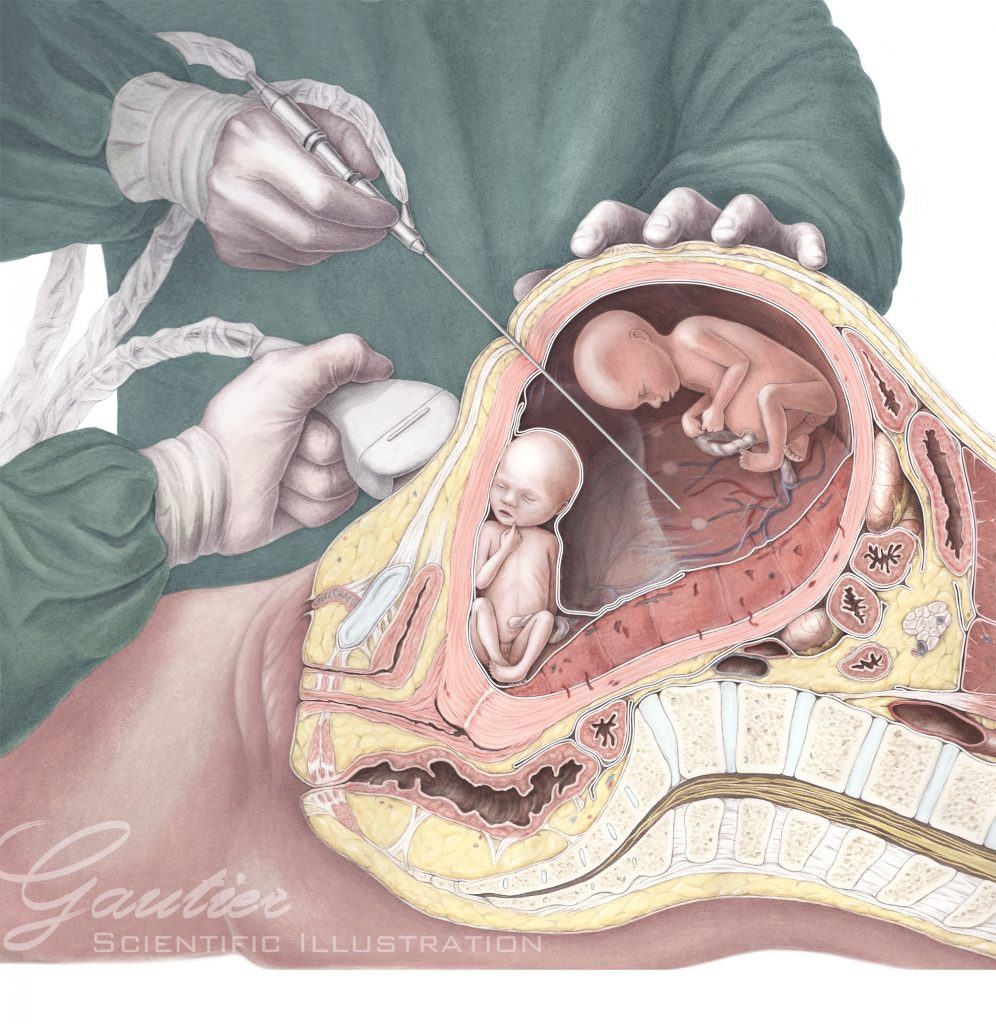 Fetal therapy