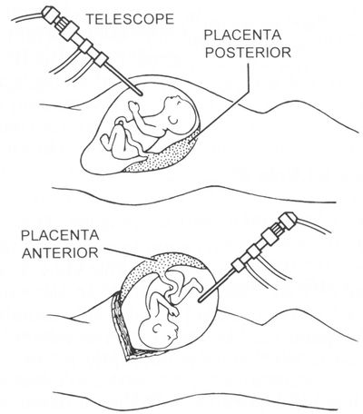 Intrauterine interventions