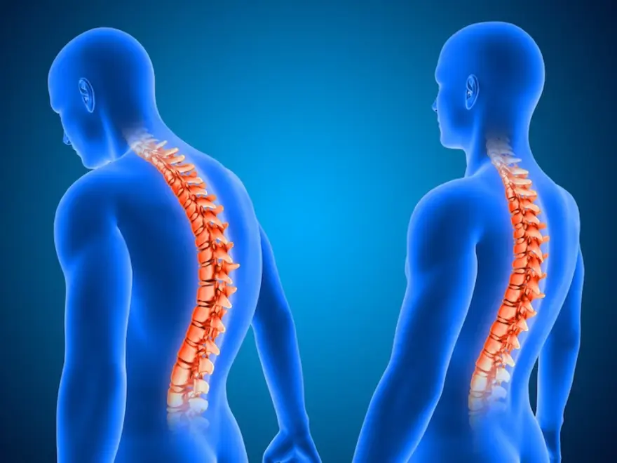 Kyphosis in nagpur
