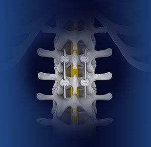 Spinal fusion is a surgical procedure that aims to join two or more vertebrae permanently, eliminating motion between them.