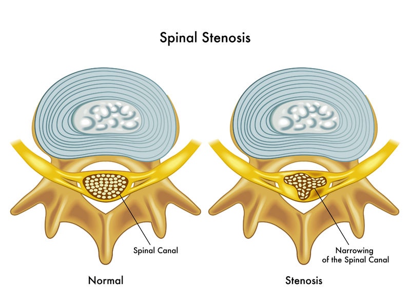 Spinal stenosis In Nagpur