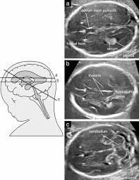 fetal neurology
