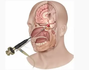 Brain Surgeon in bhilai