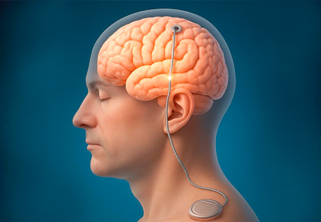 Deep Brain Stimulation In Nagpur