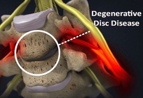 Degenerative disc disease in nagpur