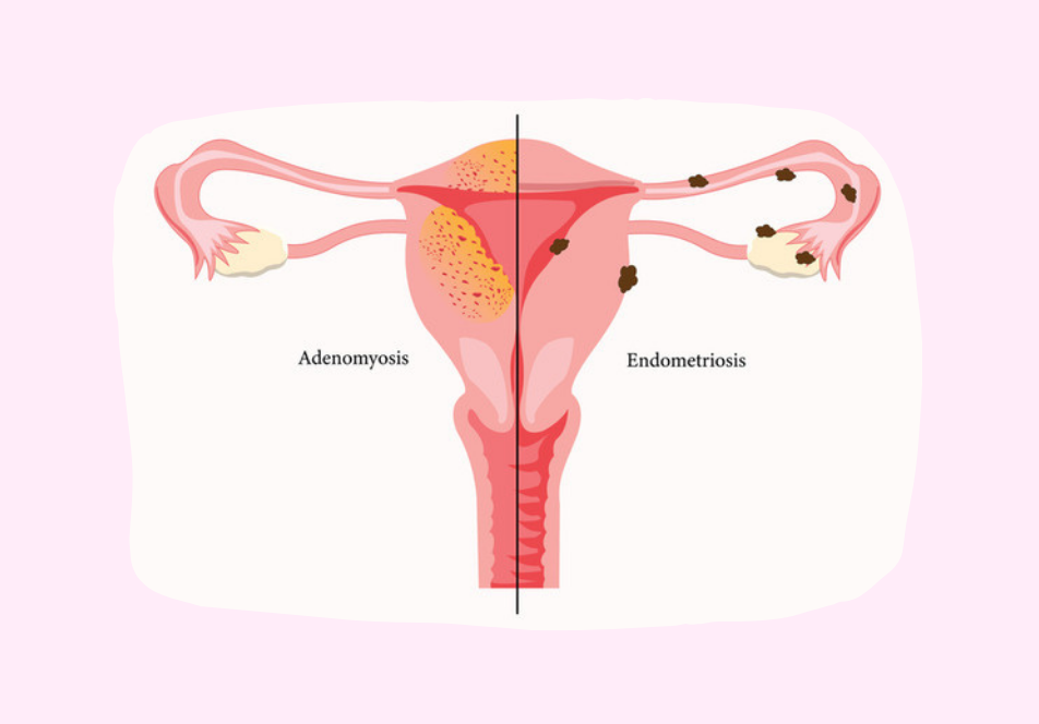 Endometriosis in nagpur