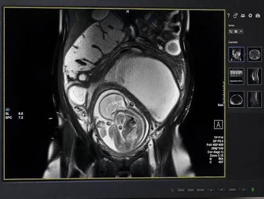 Fetal magnetic resonance imaging in nagpur