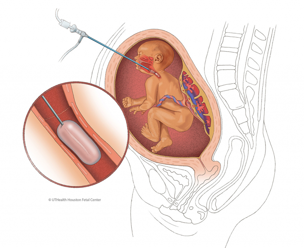Fetal surgery in nagpur