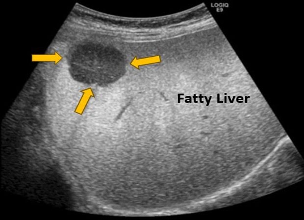 Liver ultrasound in nagpur