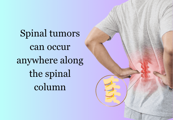 Spinal tumors in nagpur
