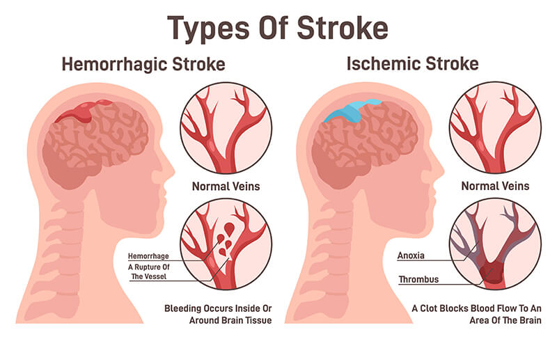 Stroke in nagpur