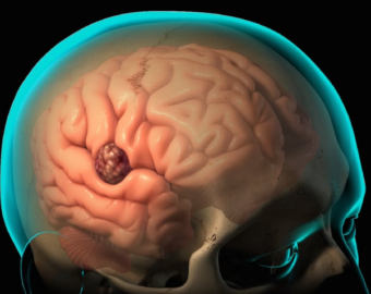 Tumor resection in nagpur