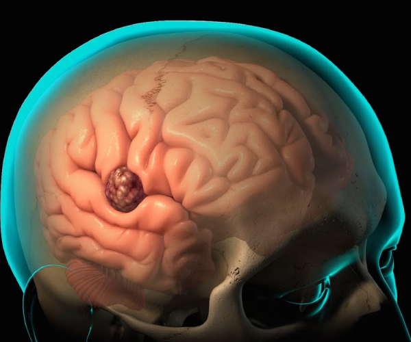 Tumor resection in nagpur