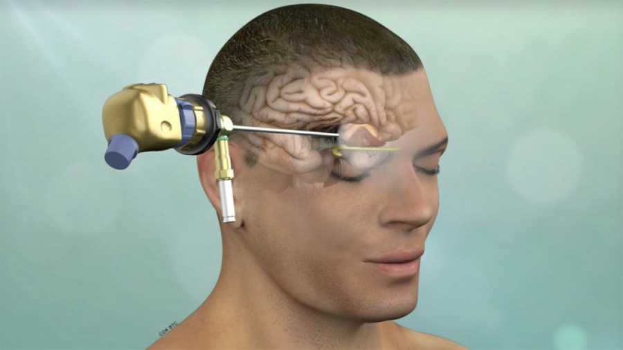 Brain surgeon in bhopal