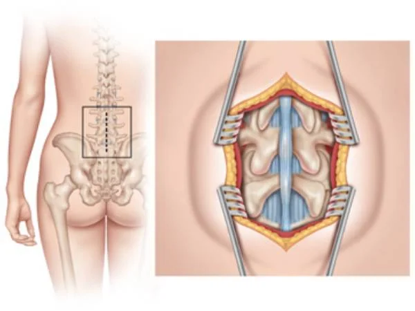 Tlif surgery in bhopal